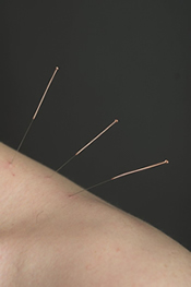 Needles in the trapezius muscle