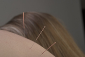 Needles in shoulder